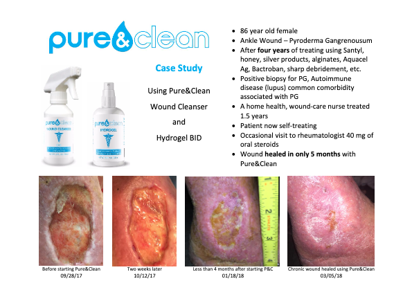 Pyoderma Gangrenosum Case Study
